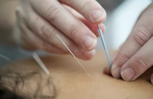Read more about the article Dry Needling