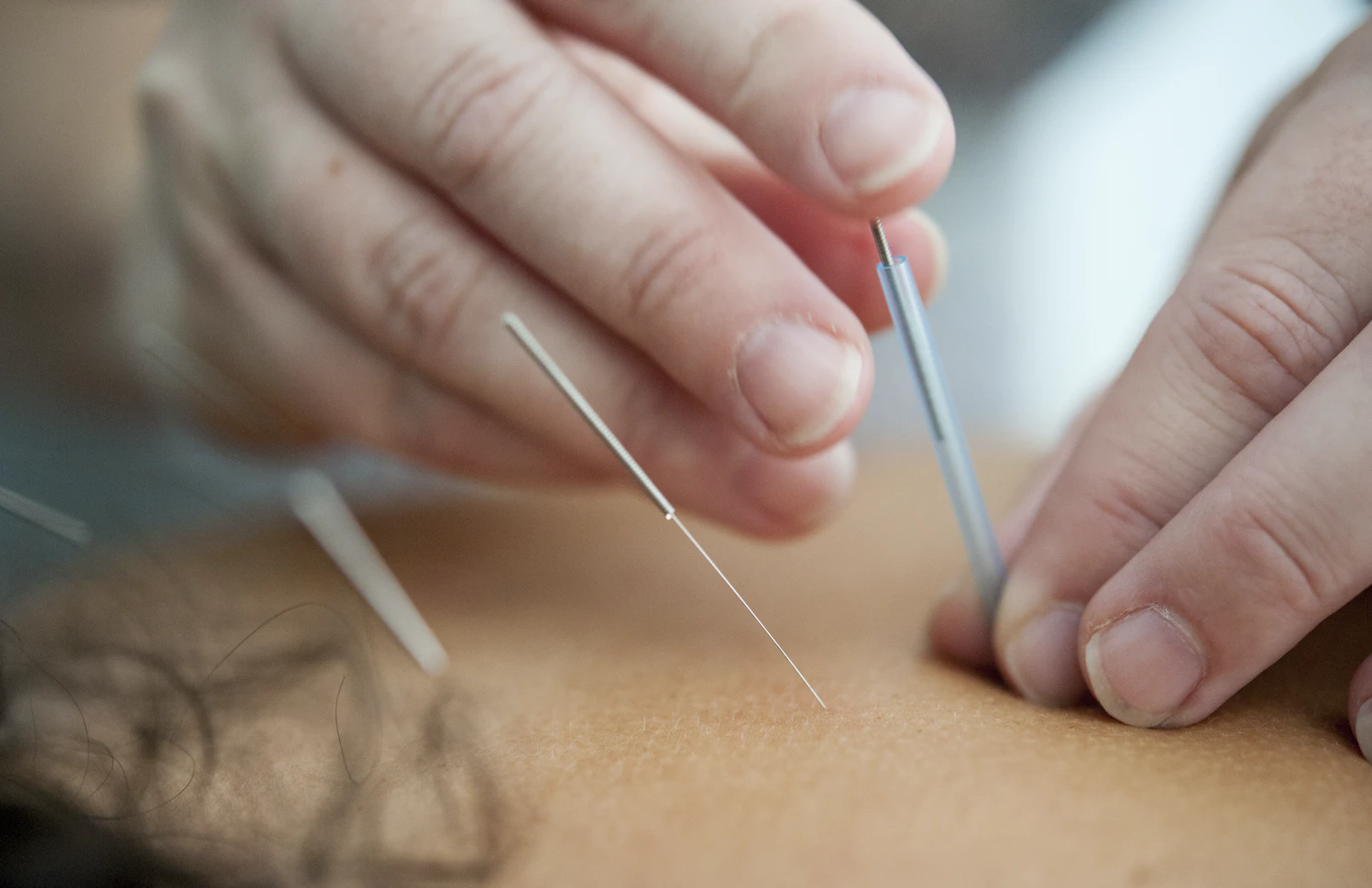 You are currently viewing Dry Needling