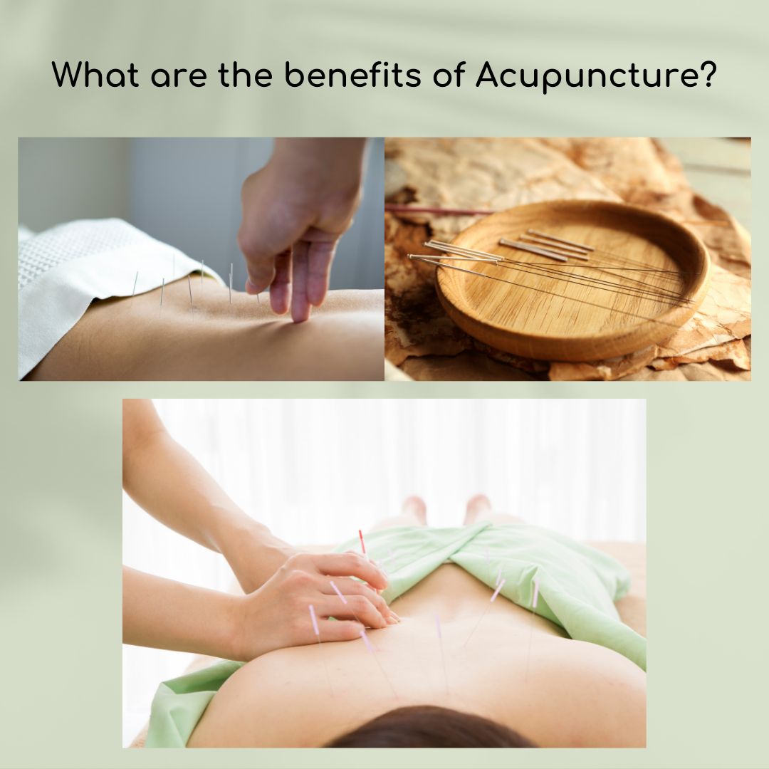 Read more about the article What are the benefits of Acupuncture?