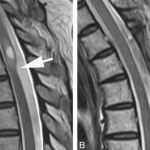 Thoracic arachnoid web myelopathy