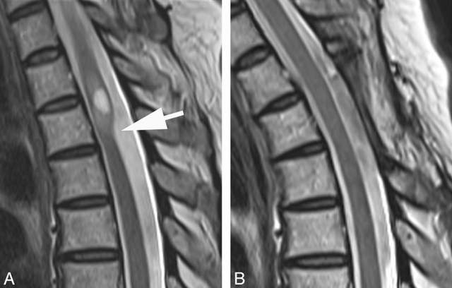 Read more about the article Thoracic arachnoid web myelopathy