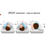 Benign Paroxysmal Positional Vertigo (BPPV)