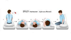Read more about the article Benign Paroxysmal Positional Vertigo (BPPV)