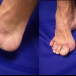 Ankle foot orthosis (AFO)